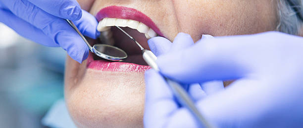 Emergency Dental Filling Replacement in IN
